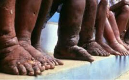 Why Nairobians Will Soon Start Having Swollen Legs and Other Body Parts?